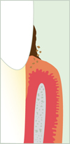 Grafik: Zahnfleischbehandlung